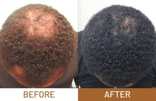 Hair Growth Pure Batana Oil+ Free Derma Roller