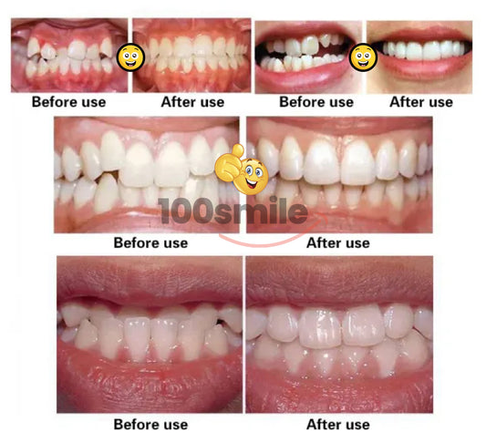 Complete 3-Step Ultra Braces Set — Permanent Teeth & Jaw Alignment Solution - Limited Offer