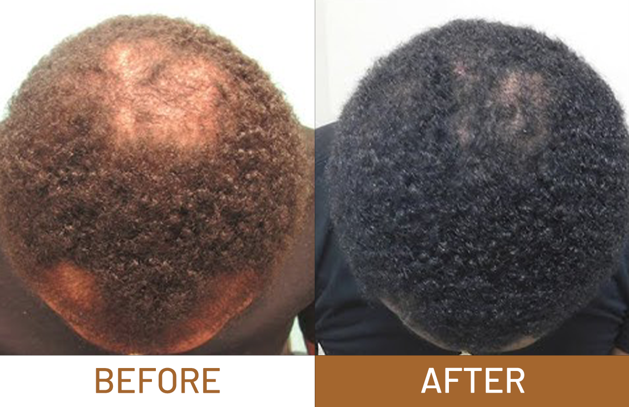 Batana Oil Pure Luxe Hair Boost Hair Growth Oil + Free Derma Roller