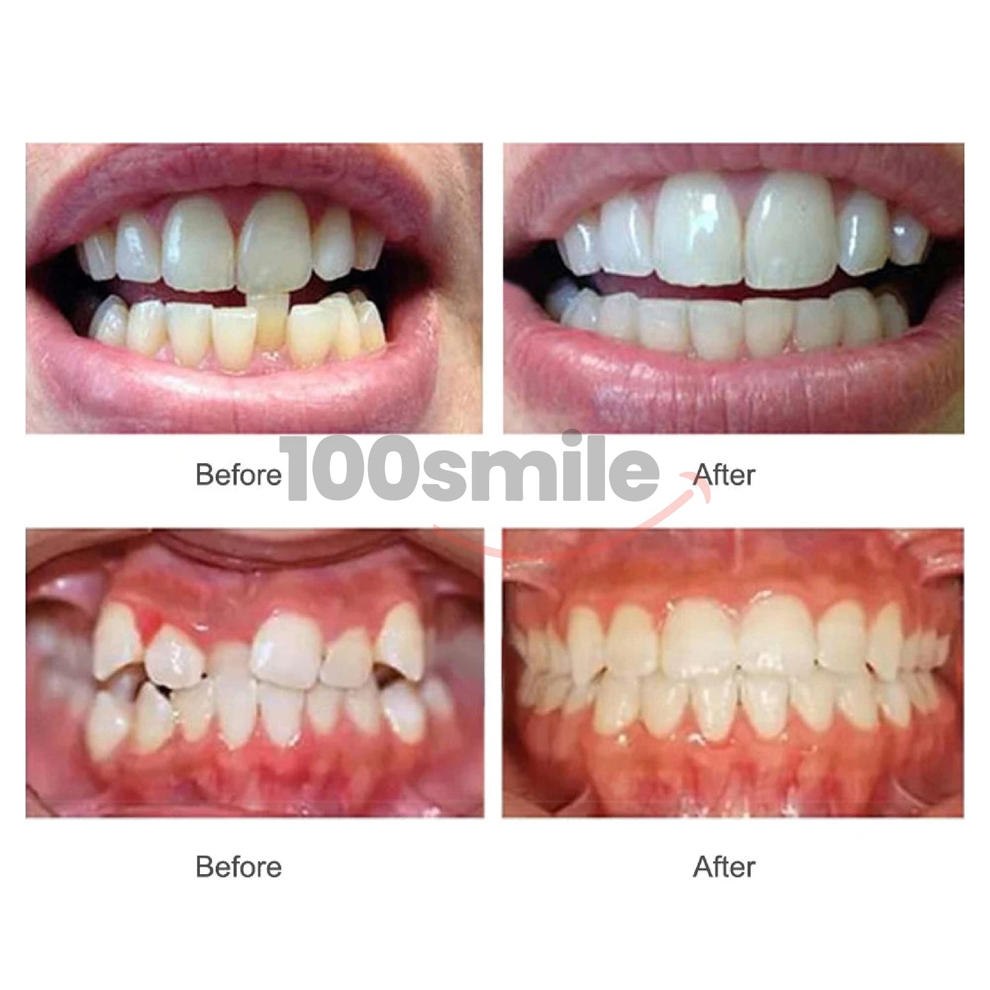 Complete 3-Step Ultra Braces Set — Permanent Teeth & Jaw Alignment Solution - Limited Offer