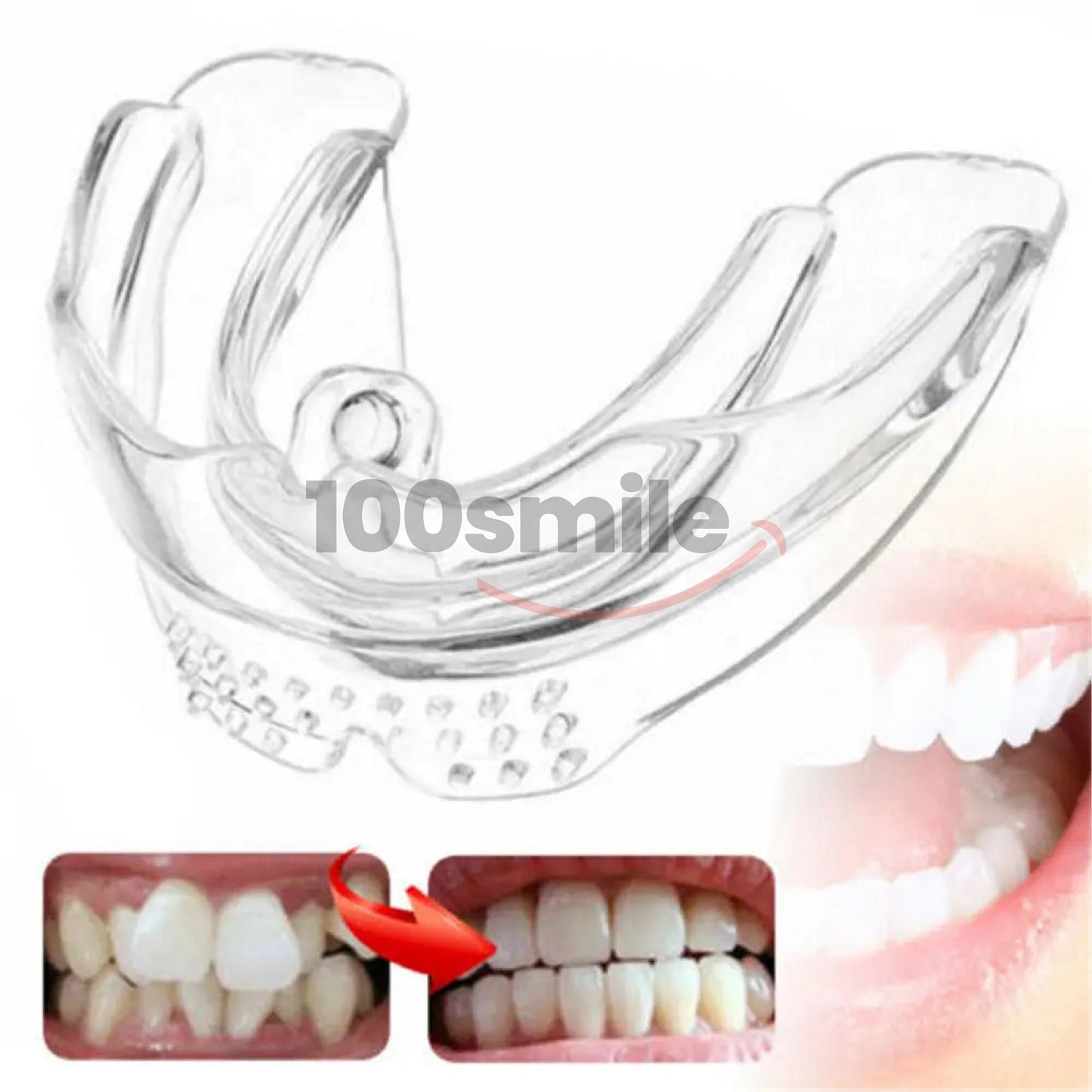 Complete 3-Step Ultra Braces Set — Permanent Teeth & Jaw Alignment Solution - Limited Offer